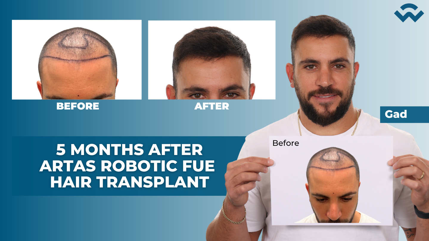 5 Months After ARTAS Robotic FUE Hair Transplant – We Grow Hair Indy