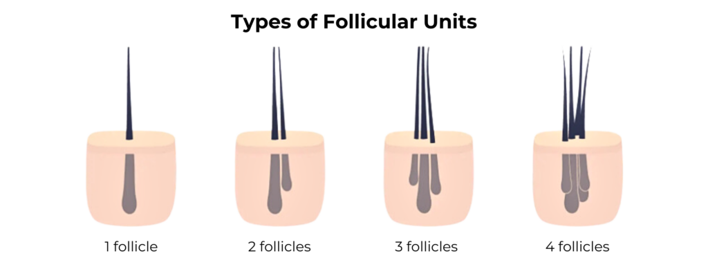 Types of Hair Grafts Follicular Units