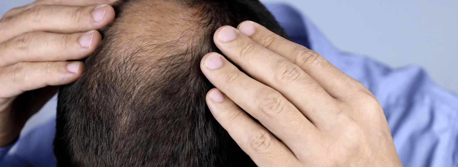 Understanding the Connection Between Stress and Hair Loss