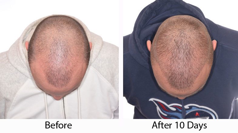 What-to-Expect-10-Days-After-Hair-a-Transplant-Procedure-blog-feb20-kyler-pics-tilt.jpg