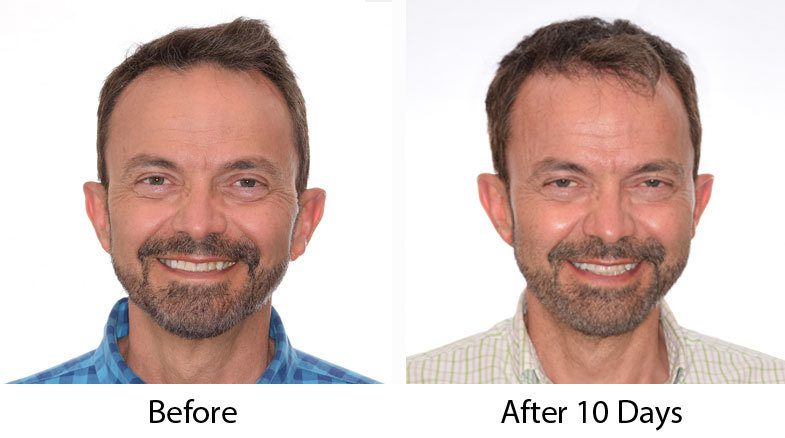 What-to-Expect-10-Days-After-Hair-a-Transplant-Procedure-blog-feb20-paul-pics-front.jpg