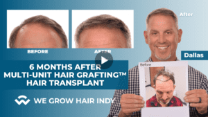 Dallas 6 months after Hair Transplant Results