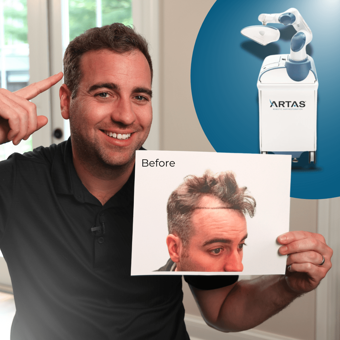 Robotic Hair Transplant Results