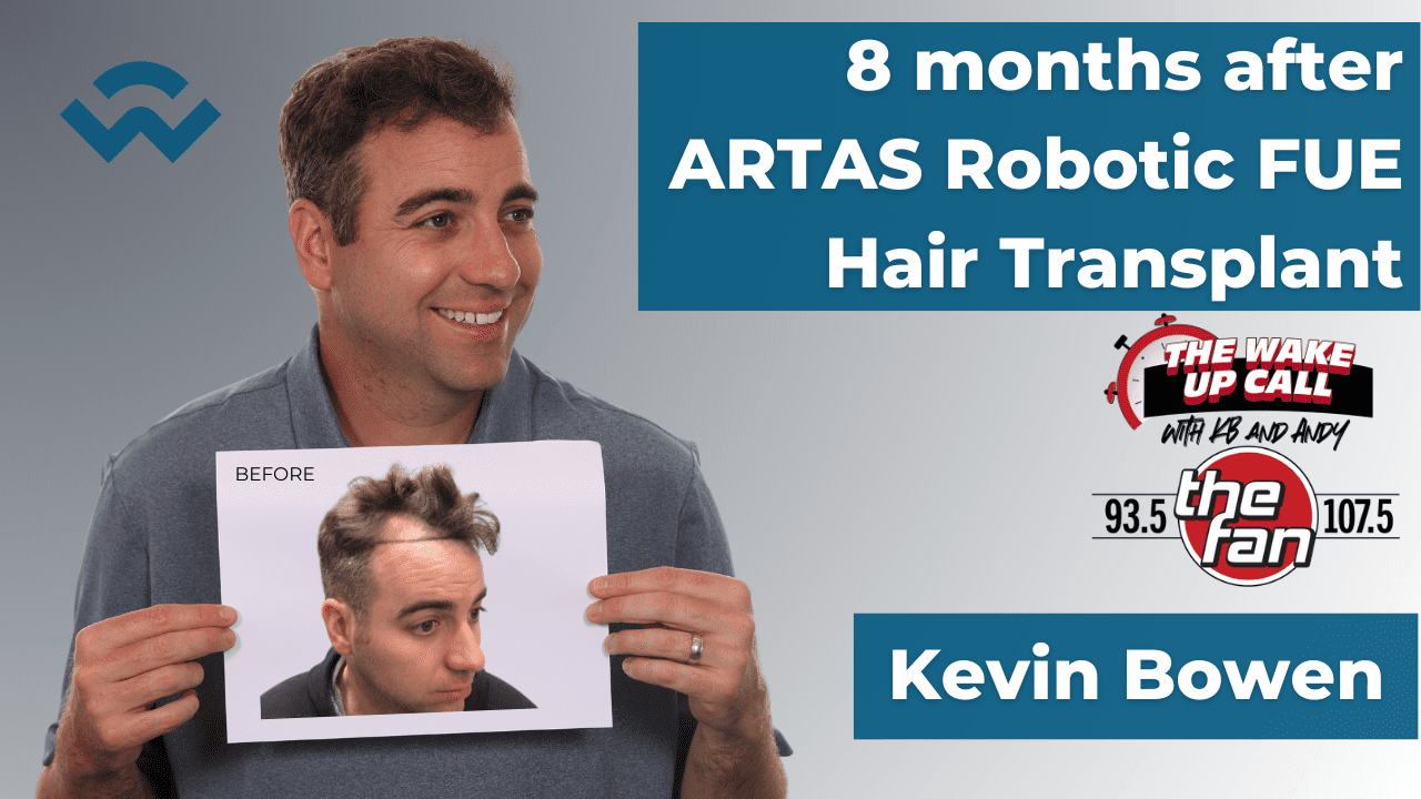 8 Months after ARTAS Robotic FUE Hair Transplant