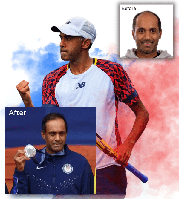 Rajeev Ram Olympics Hair Transplant