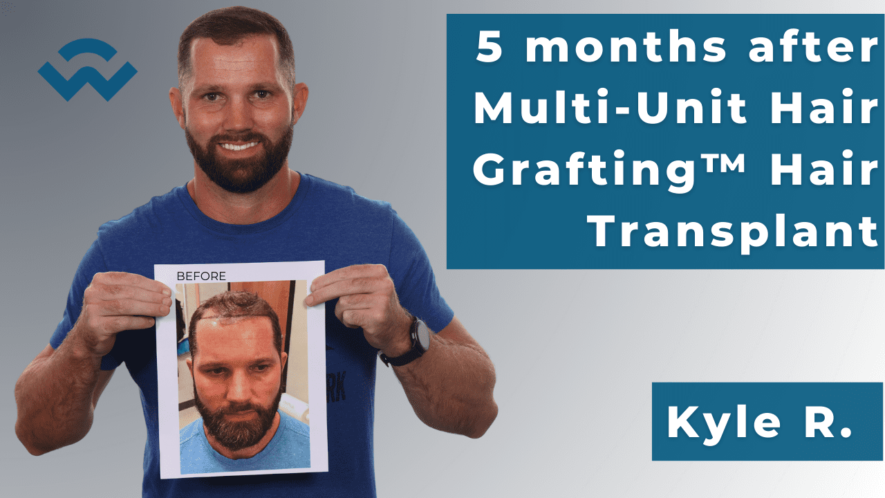 5 Months after a Multi-Unit Hair Grafting™ Hair Transplant