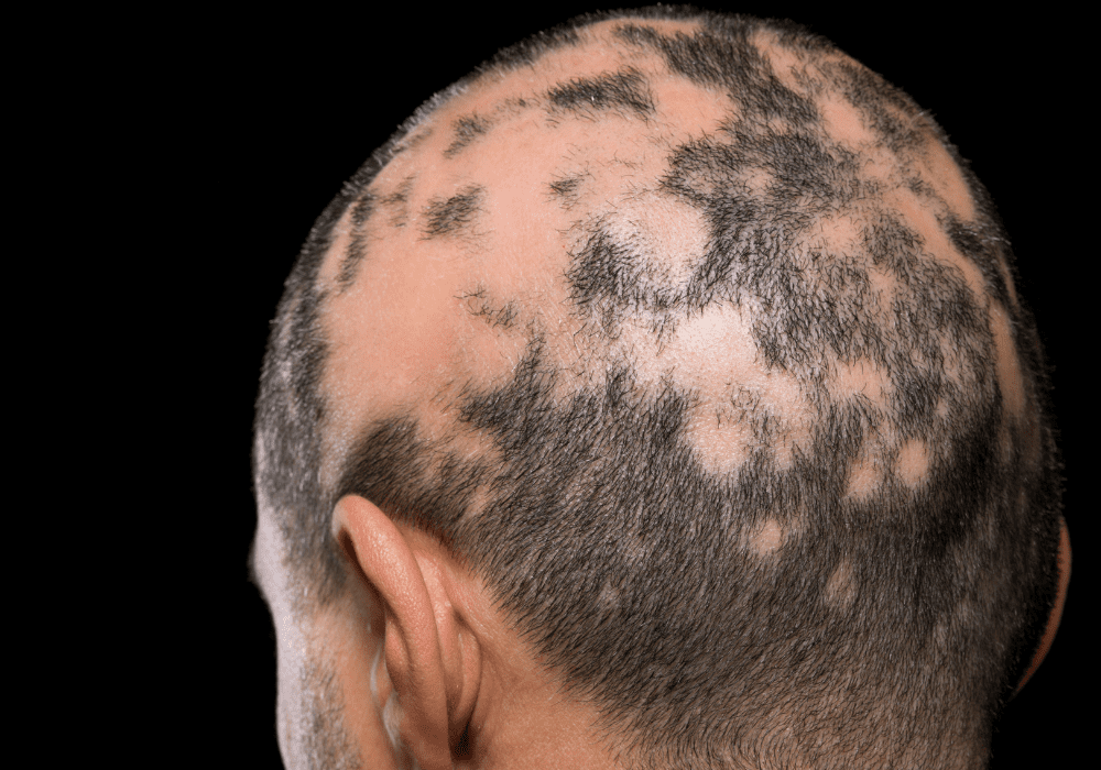 an example of alopecia areata