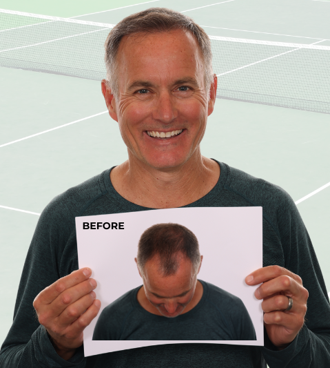 brad dancer holding his before picture from his hair transplant