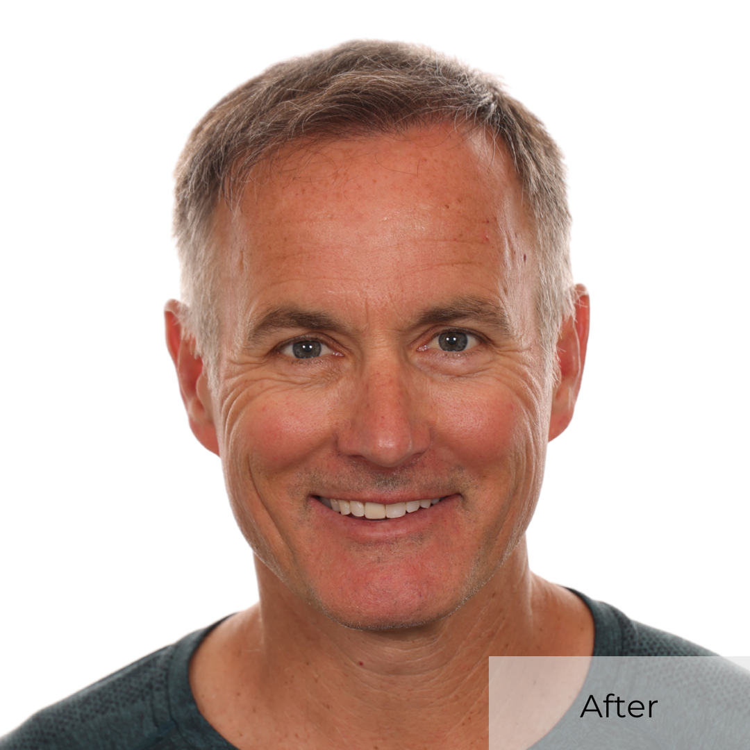 Brad Dancer final results of hair transplant