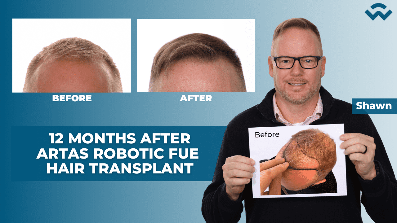 12 Months after ARTAS Robotic FUE Hair Transplant