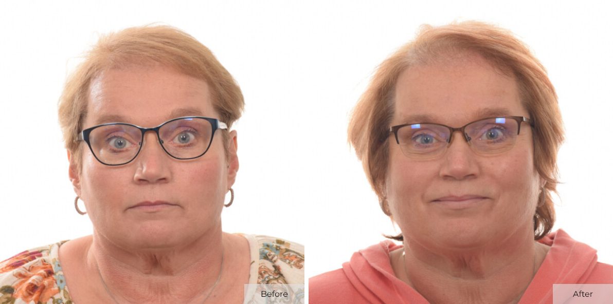 22-Before-After-1-1.jpg