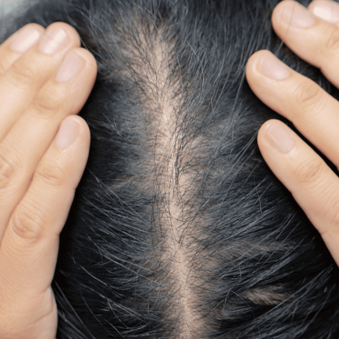 Hair Loss from Ozempic, Wegovy (semaglutide) - Weight Loss Drugs