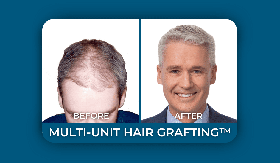 The History of Hair Transplants