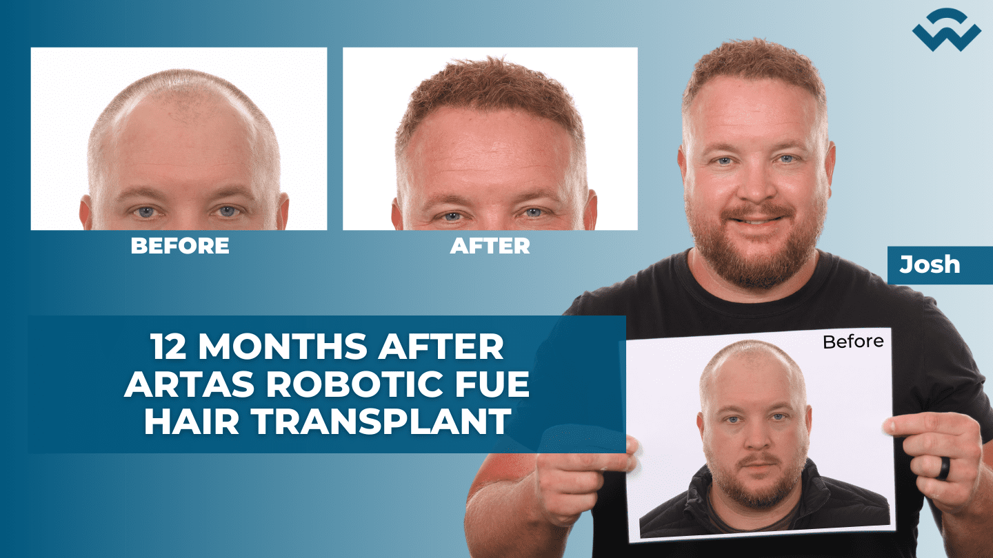 1 Year After Hair Transplant - ARTAS Robotic FUE