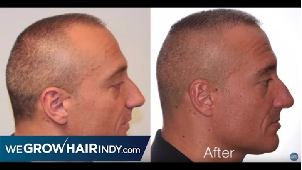 ARTAS Robotic FUE Hairline Transplant 4 Mo Results | Alex