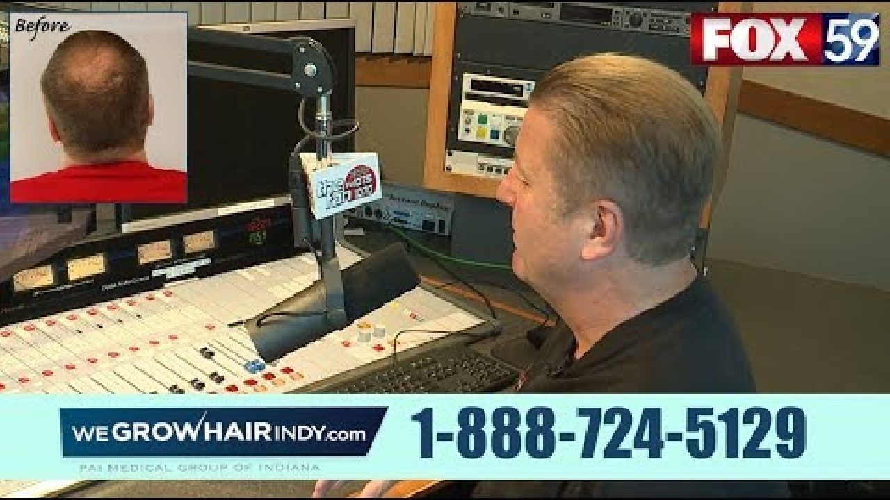 Crown Hair Transplant | JMV 1070 The Fan on Fox 59 Marketplace