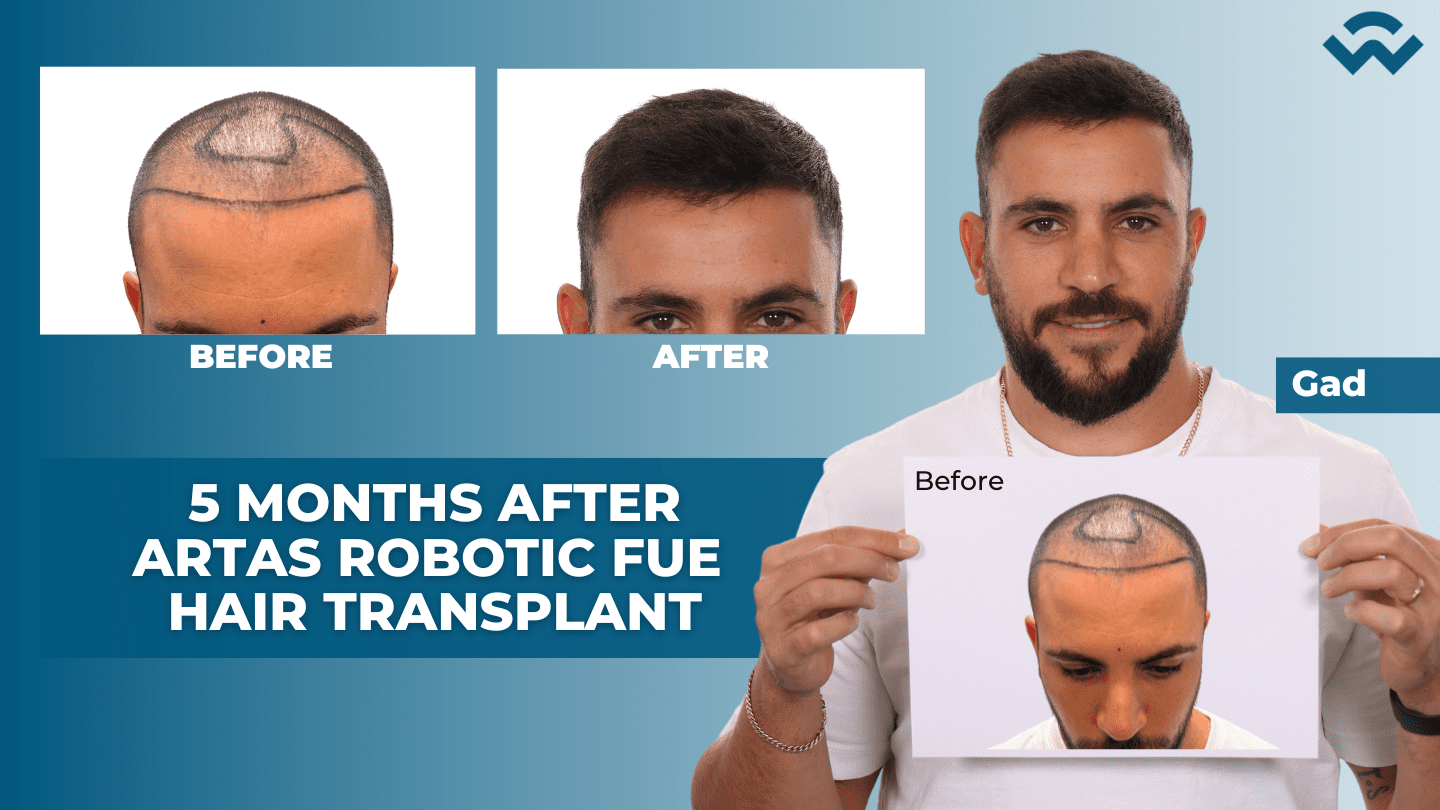 5 Months After ARTAS Robotic FUE Hair Transplant - We Grow Hair Indy