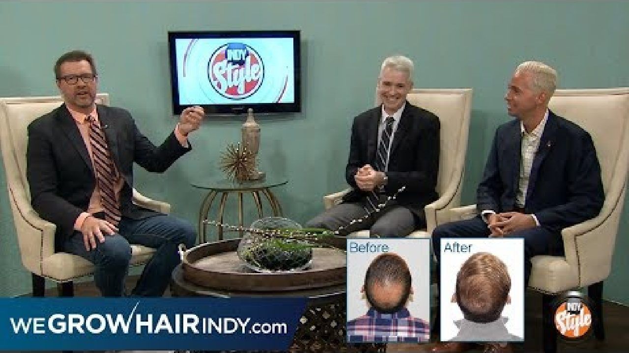 Hair Transplant After Medical Hair Loss - PAI on Indy Style to Discuss