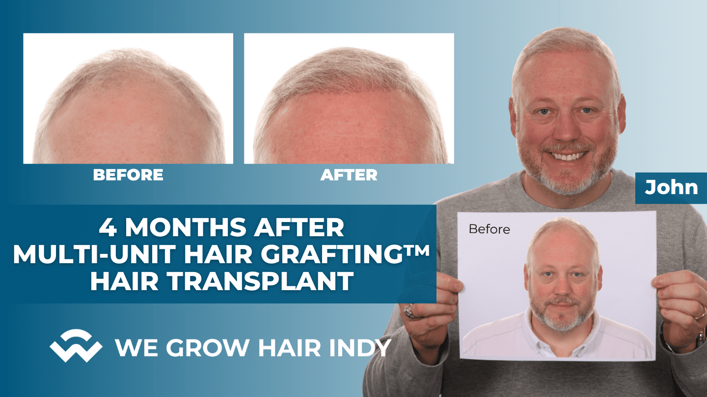 4 Months After Multi-Unit Hair Grafting™ Hair Transplant - John