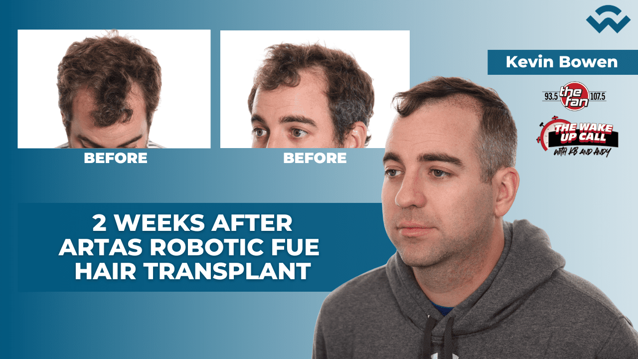 ARTAS Robotic FUE | 2 Weeks Later with Kevin Bowen