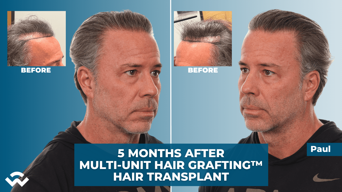 5 Month Hair Transplant Results - Multi-Unit Hair Grafting™ Hair Transplant