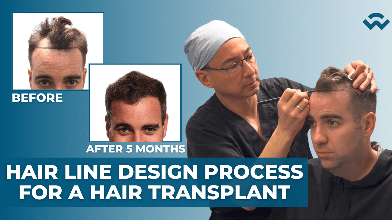 Step-by-Step: Hair Transplant Hair Line Design Process