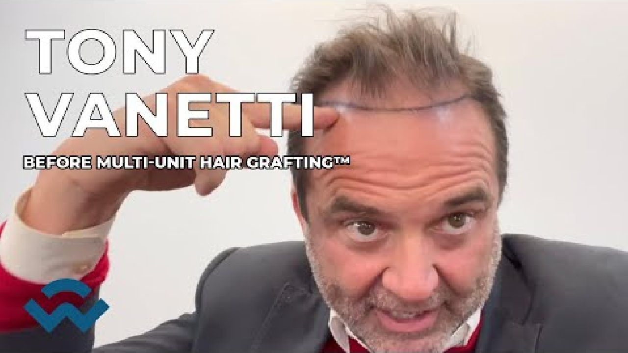 Tony Vanetti Hairline Mapping