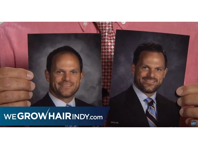 Benefits of a Hair Transplant - Multi-Unit Hair Grafting™