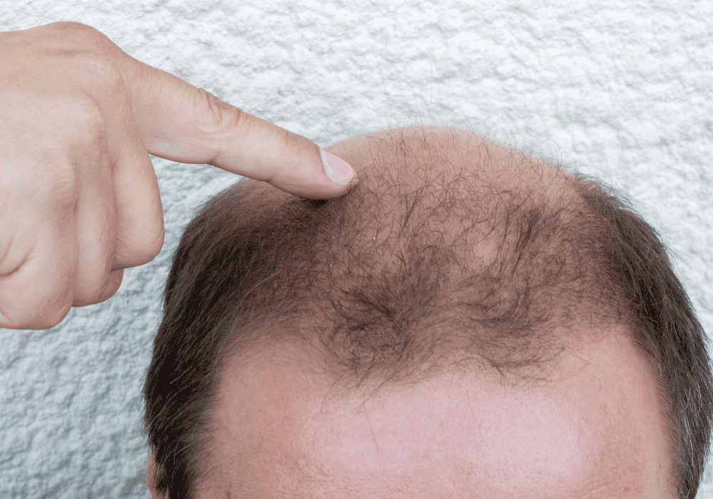 Hair Loss Awareness Month: Understanding, Preventing, and Treating Hair Loss