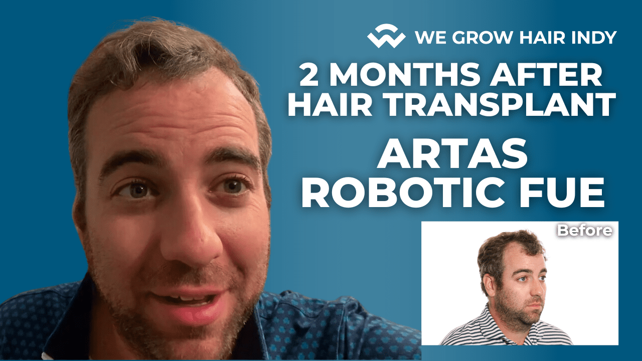 2 Months after an ARTAS Hair Transplant with Kevin Bowen