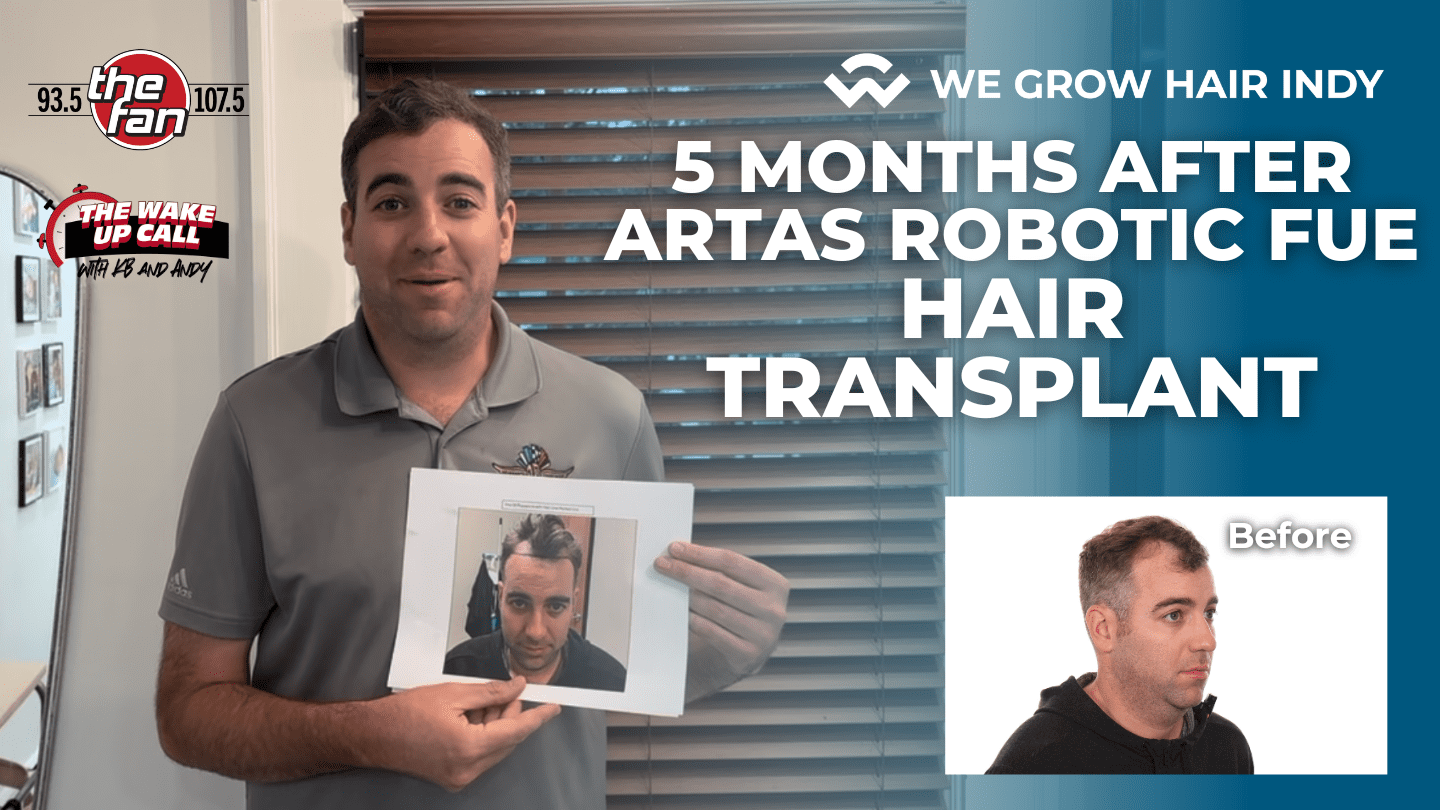 Kevin Bowen - 5 Months After Hair Transplant