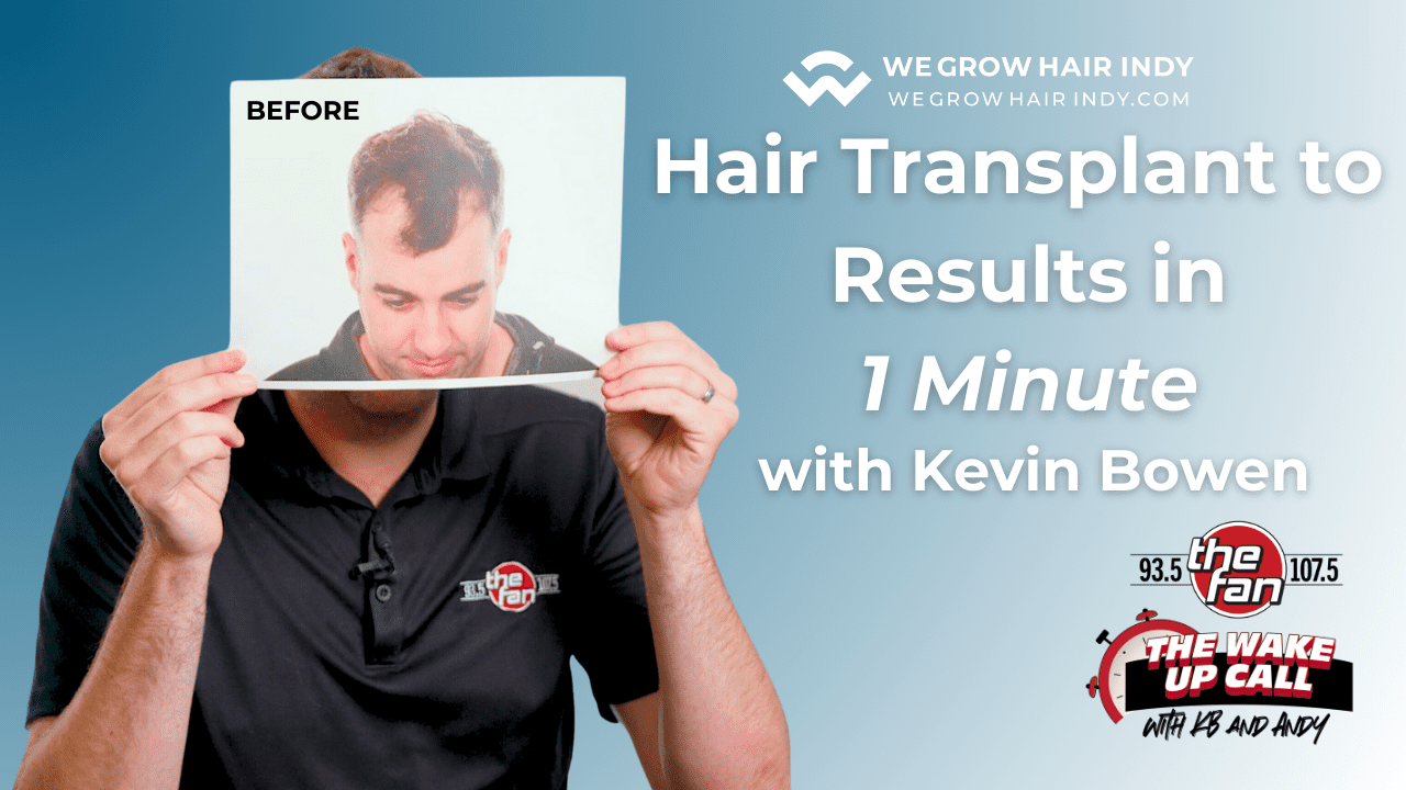 Hair Transplant to Results in 1 Minute with Kevin Bowen