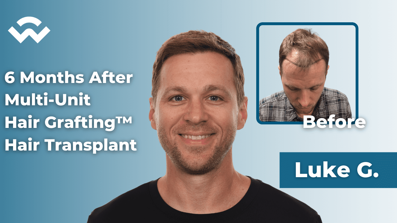 Hair Transplant Results after 6 Months