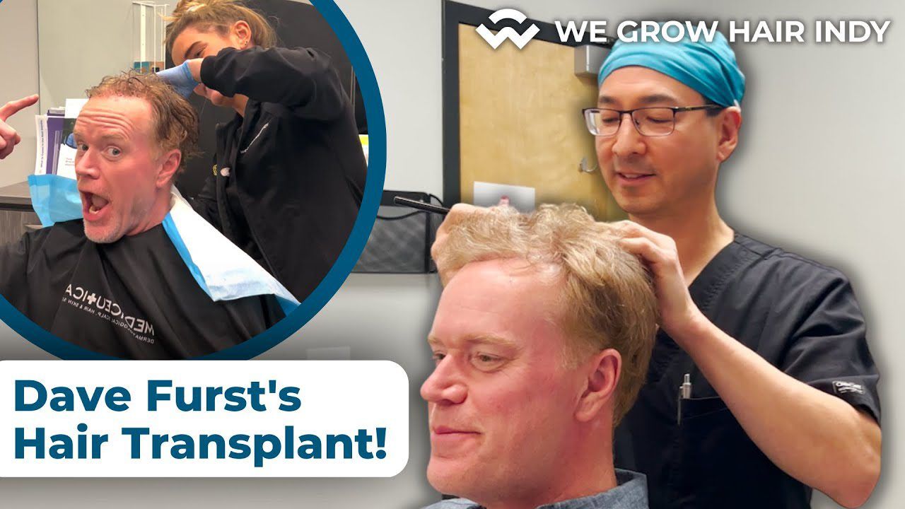 Day of Multi-Unit Hair Grafting™ Hair Transplant - Dave Furst