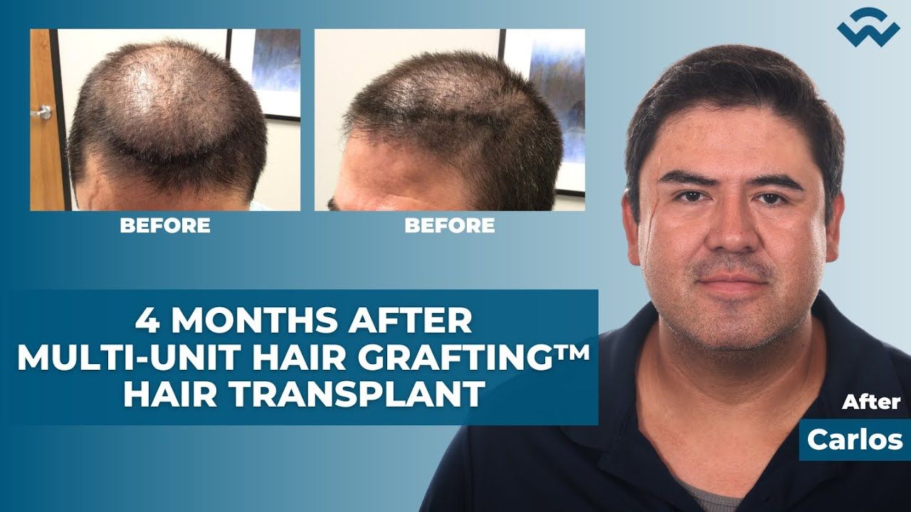 4 Month Follow-Up After Multi-Unit Hair Grafting™ Hair Transplant - Carlos Rincon