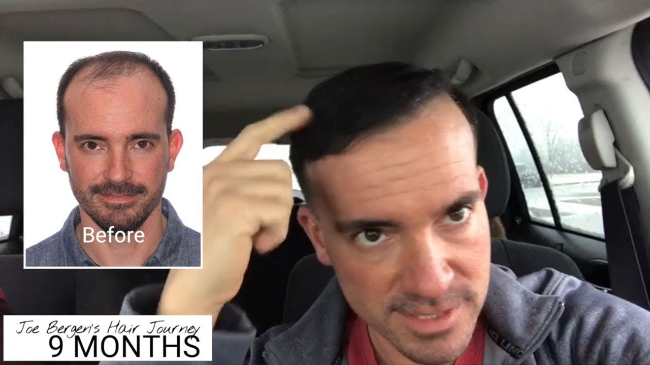 Joe Bergen Multi-Unit Hair Grafting™ 12 Month Journey