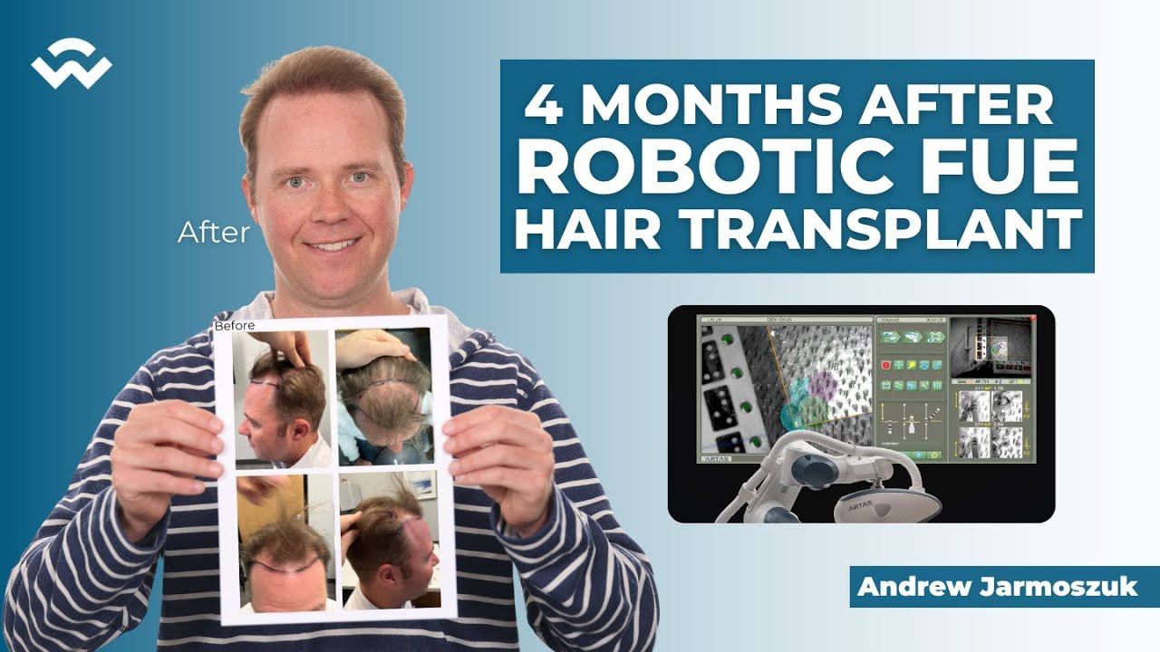 4 Month Result After ARTAS Robotic FUE Hair Transplant - We Grow Hair Indy | Andrew