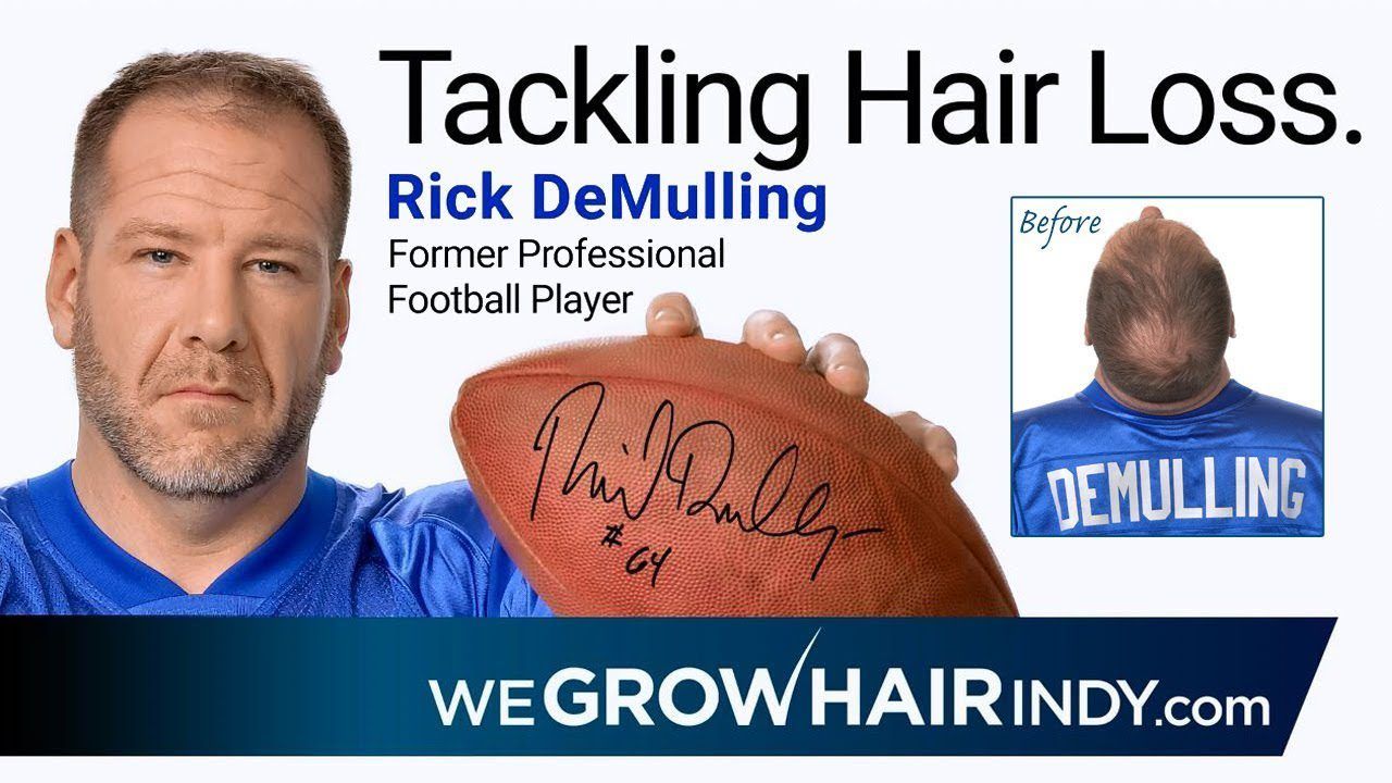 New Hair Transplant VIP! Former Pro Football Player - Rick DeMulling