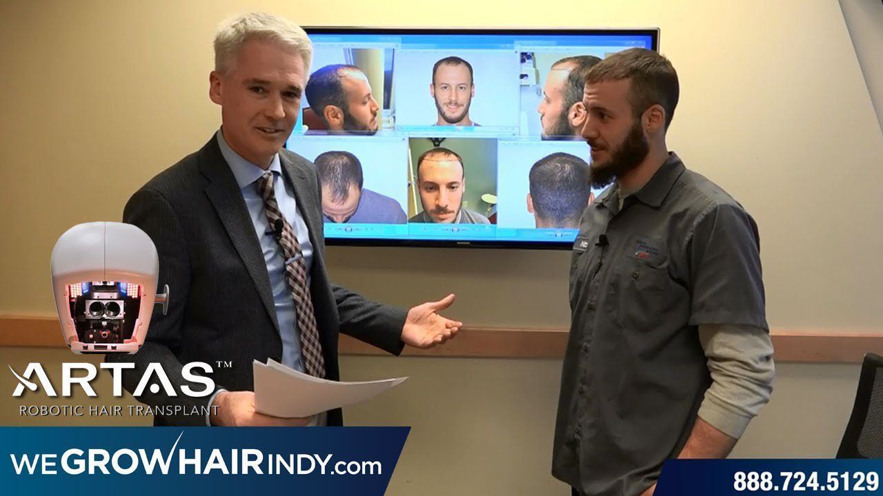 ARTAS FUE Hair Transplant 4 Mo Follow Up - Nick