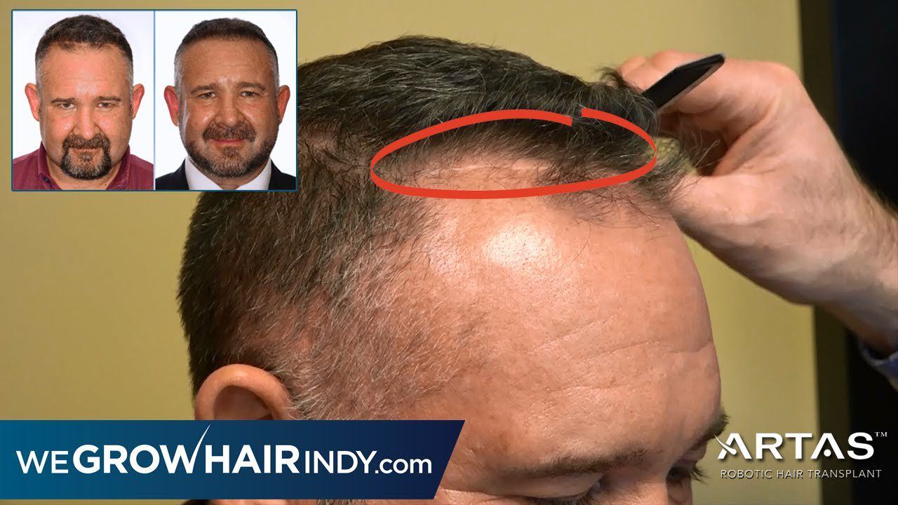 ARTAS FUE Hair Transplant | US Marine Scar Repair