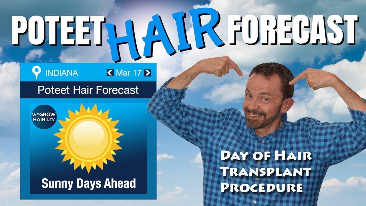 Hair Transplant Procedure - Paul Poteet (Mister Weatherman) FULL VERSION