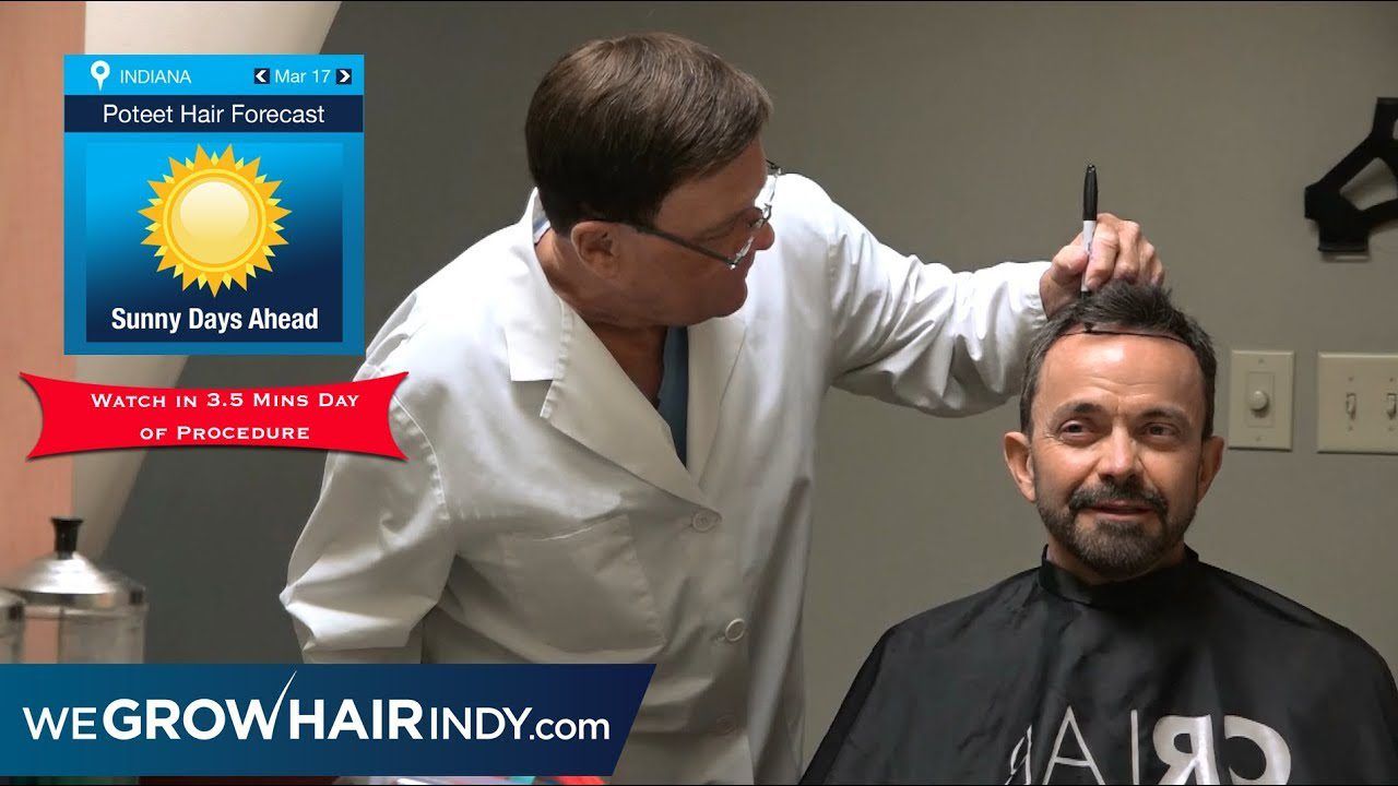 Hair Transplant Procedure WATCH IN 3.5 MINS - Paul Poteet (Mister Weatherman)