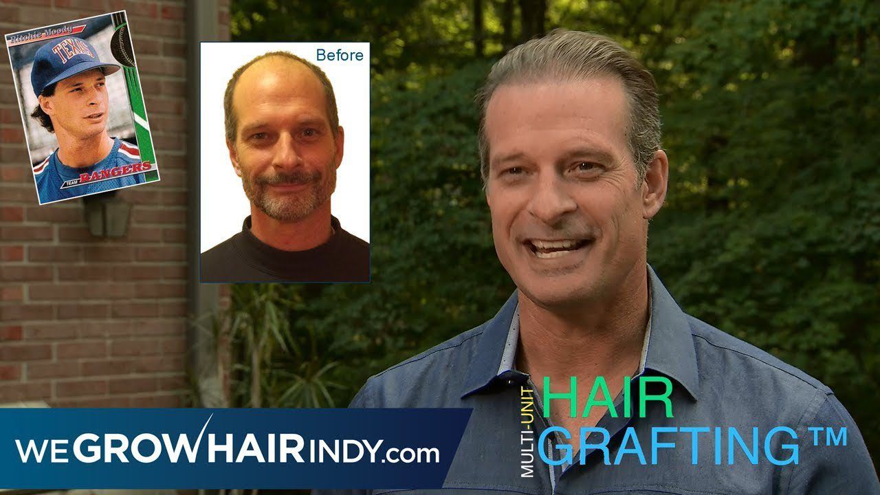 Hair Transplant Before and After | Former Professional Baseball Player Ritchie Moody