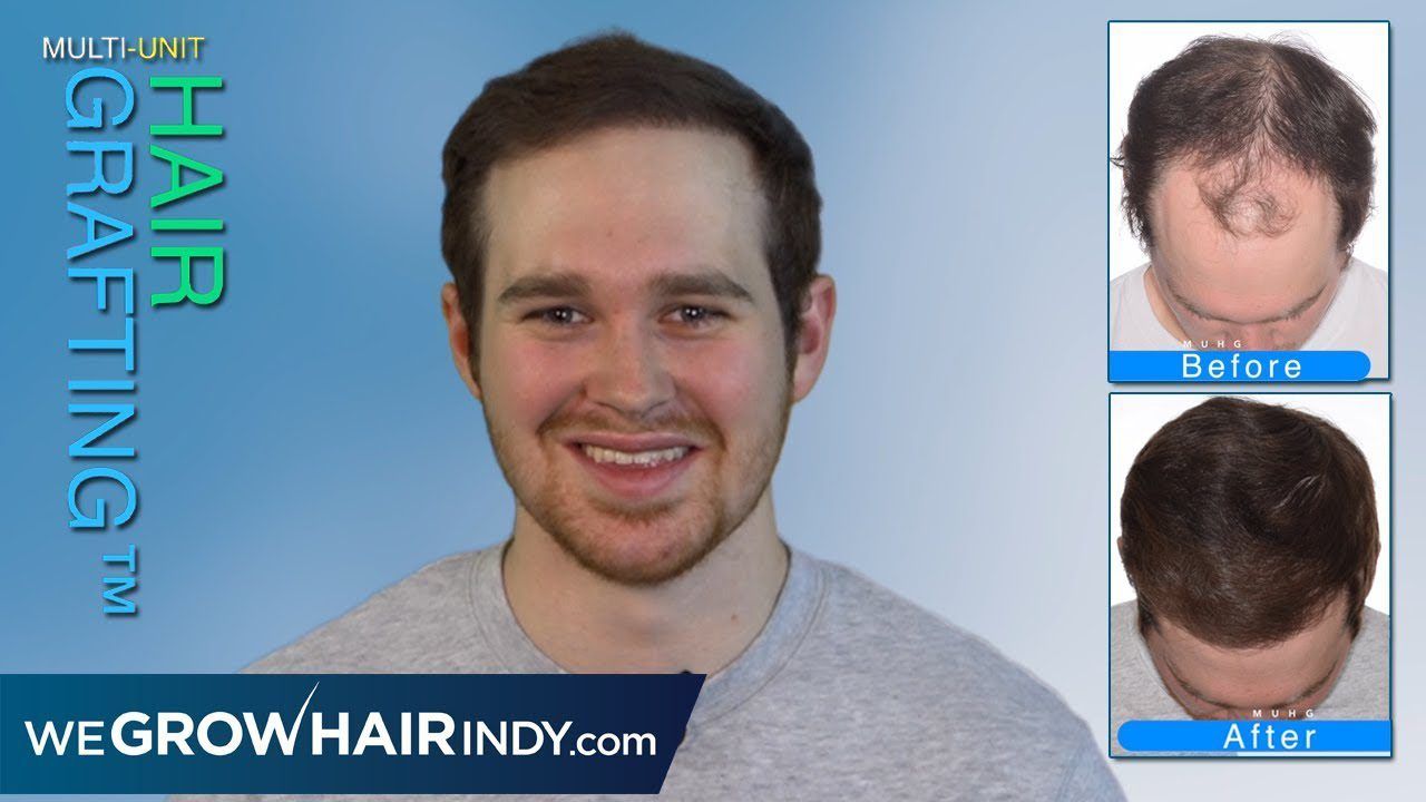 Confidence Restored | Max Density Hair Transplant