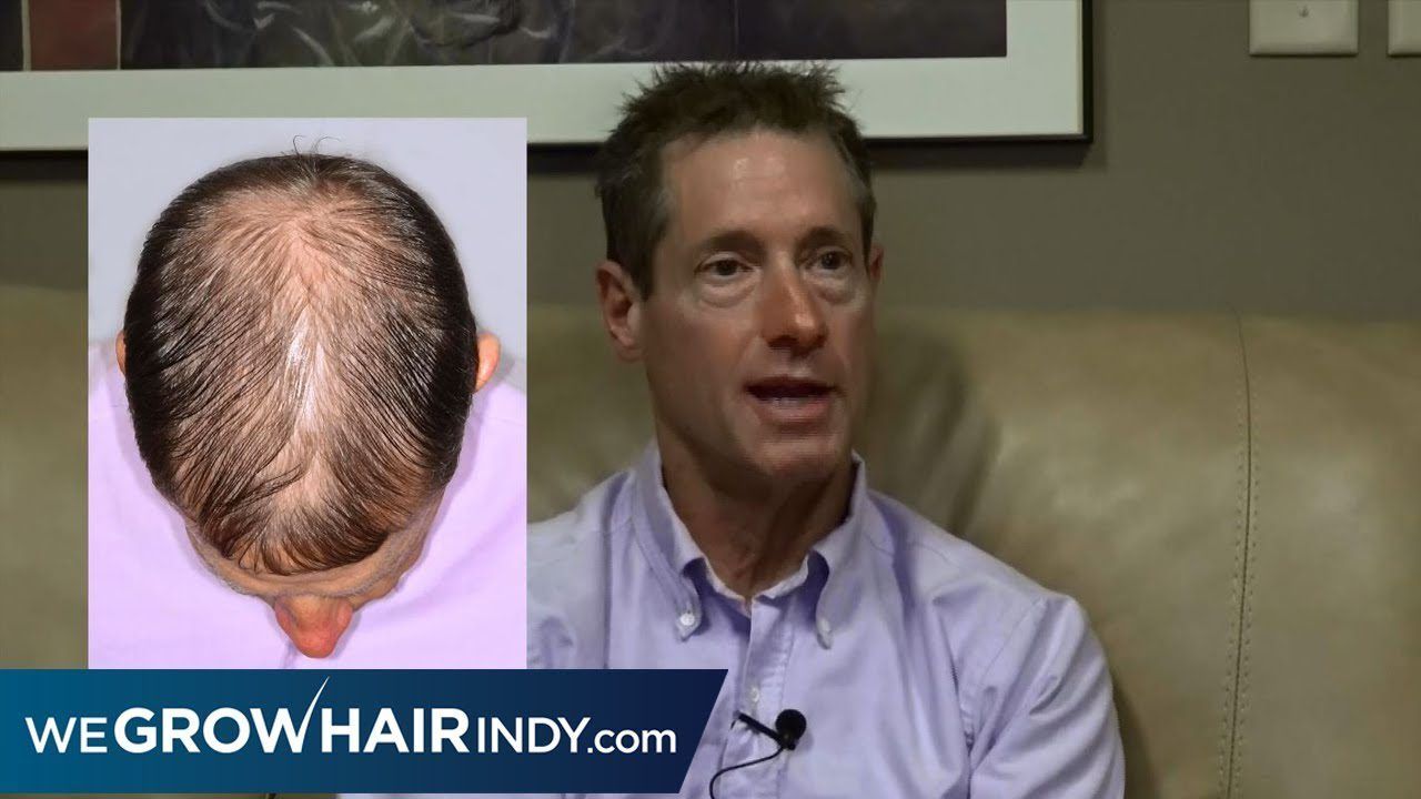 Hair Transplant Procedure | David