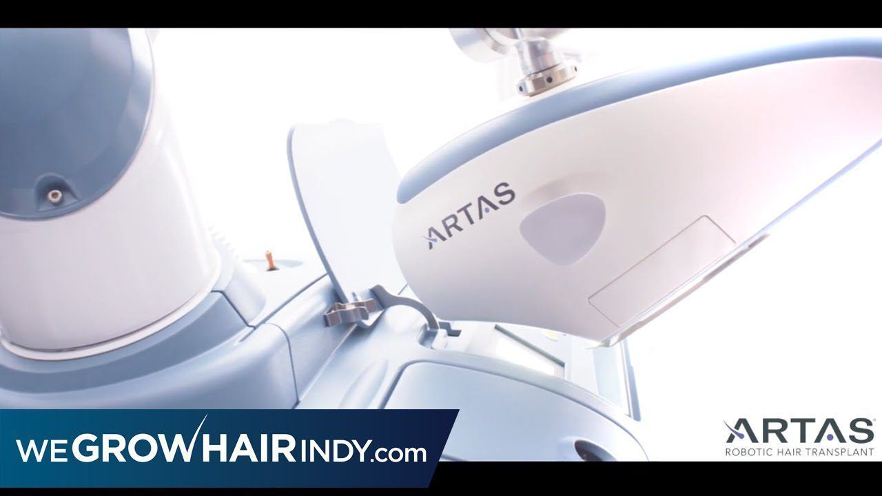 Best FUE Hair Transplant Method - ARTAS Robotic FUE