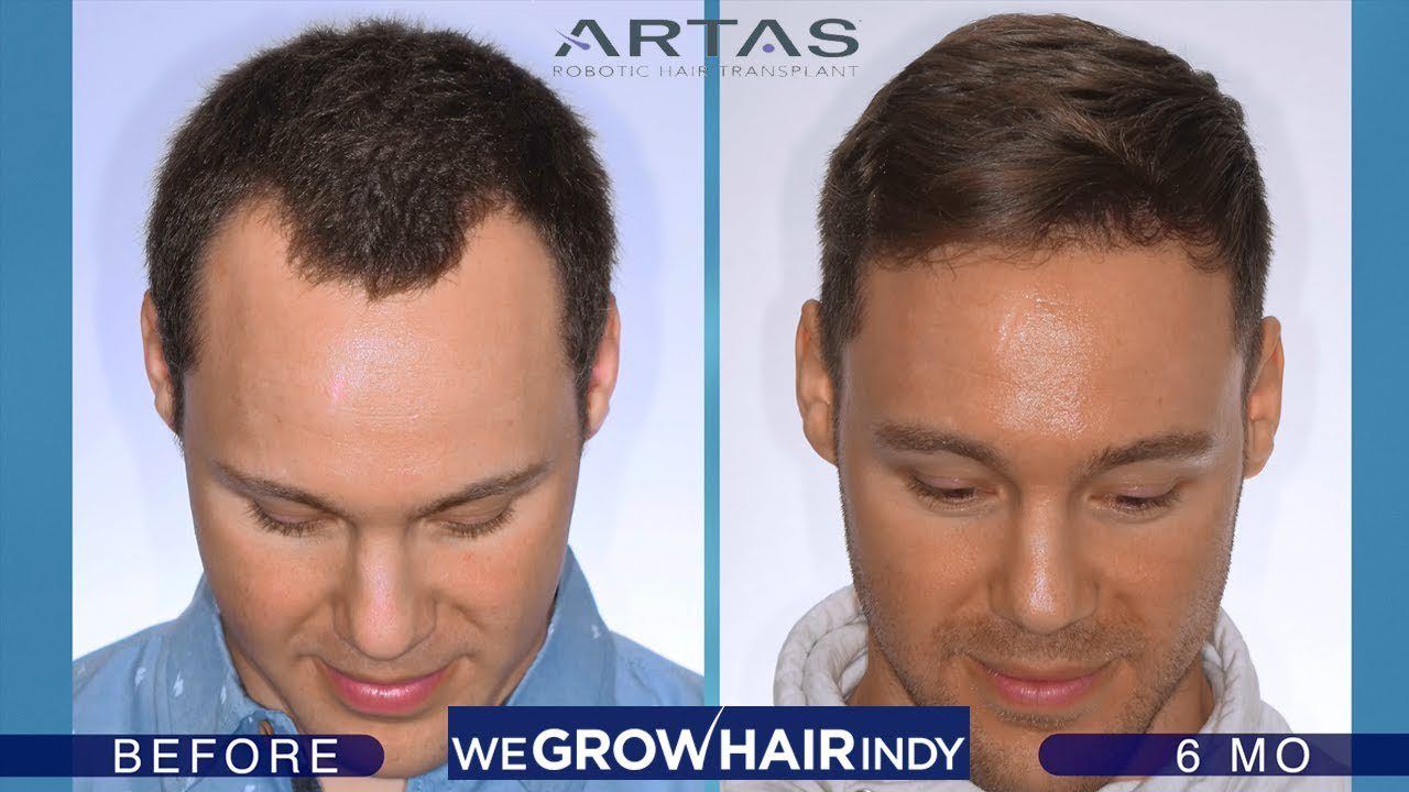 Hairline Hair Transplant - ARTAS Robotic FUE (6 Months Post Procedure)