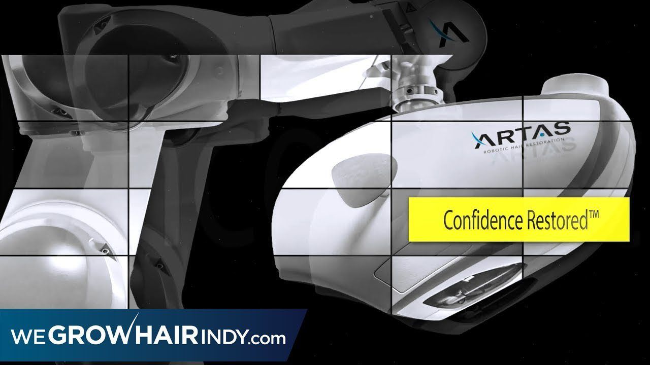 Most Advanced FUE Hair Transplant - ARTAS Robotic FUE