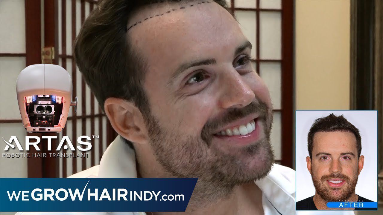 ARTAS Robotic FUE Hair Transplant | Cosmetic Doctor