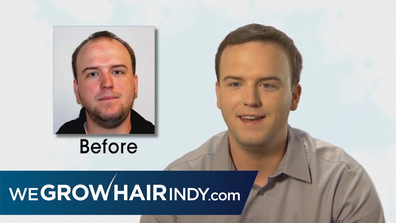 Hair Transplant After 12 Months